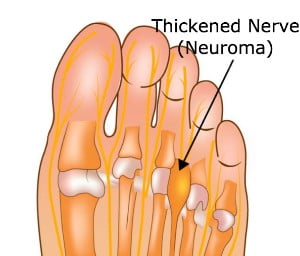 An Illustraion of the front of the foot and showing the thickened nerve orneuroma.
