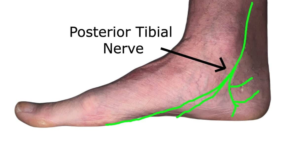 A photograph of the medial side of a quite flat foot with a green line drawn in which represents the Posterior Tibial nerve.