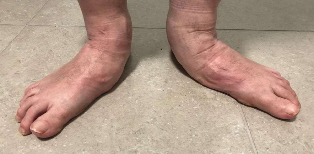 A pair of very flat feet