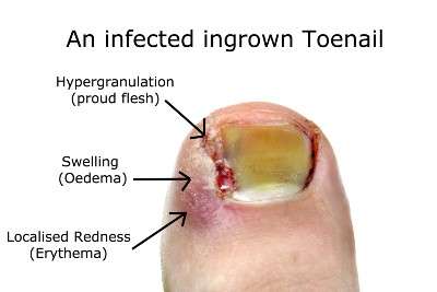 A severely infected ingrown toenail with arrows pointing to the redness, the proud flesh and the swelling